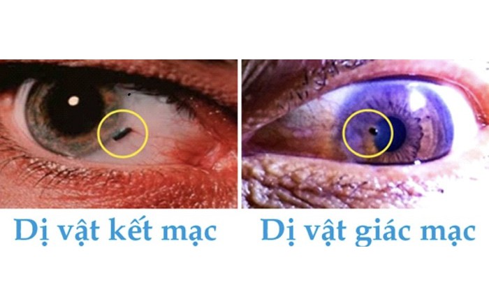 Dị vật trong mũi gây nguy hại như thế nào và cách phát hiện sớm- Ảnh 2.