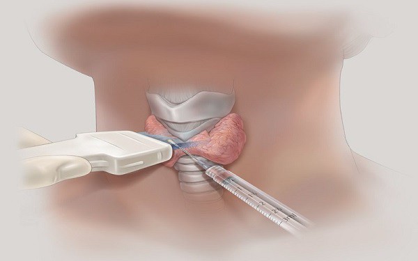 Bướu nhân tuyến giáp, nên mổ thay đốt sóng cao tần? - Ảnh 3.