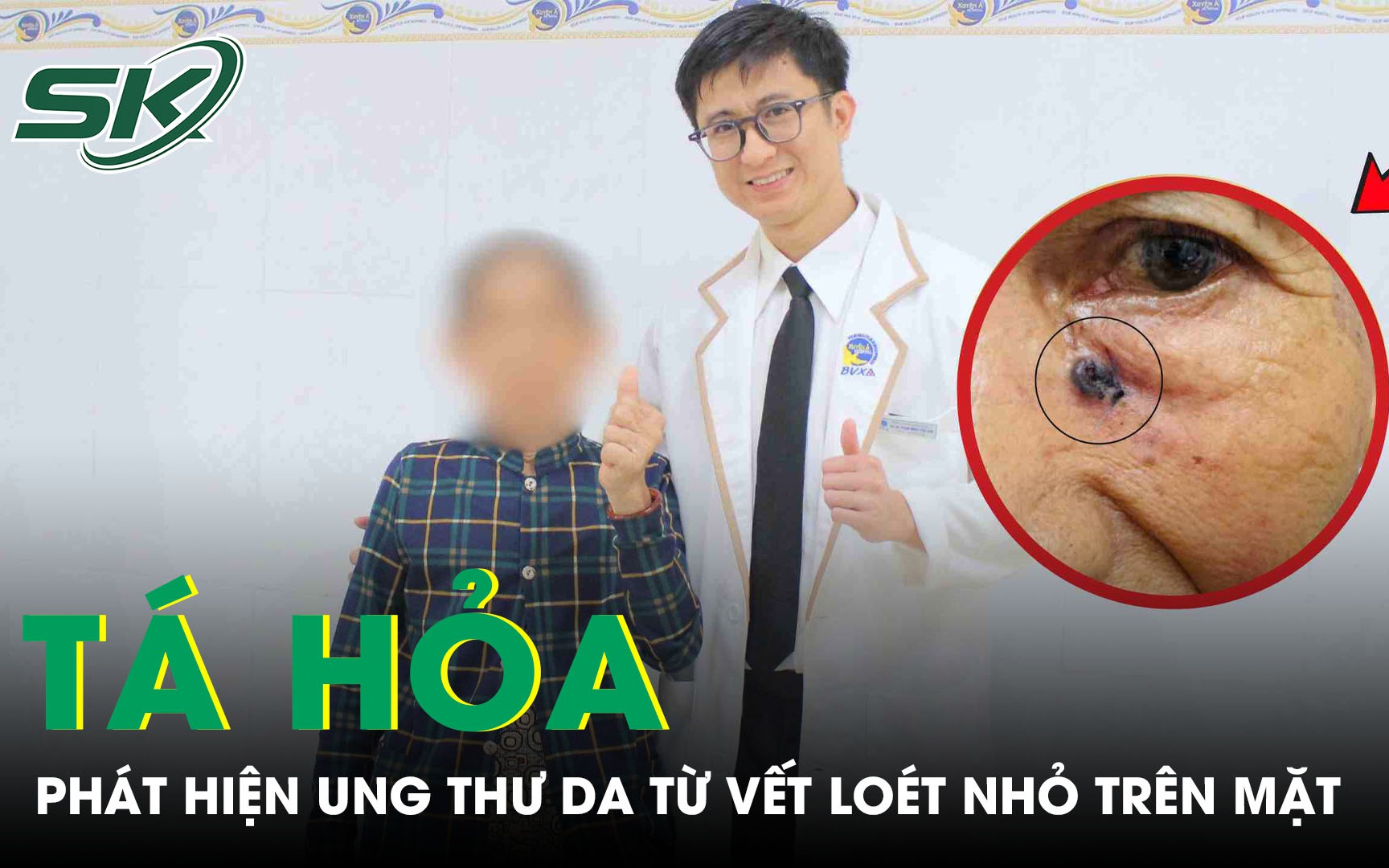 Mảng đen dưới lòng bàn chân: Dấu hiệu ung thư da dễ bị bỏ qua - Ảnh 4.