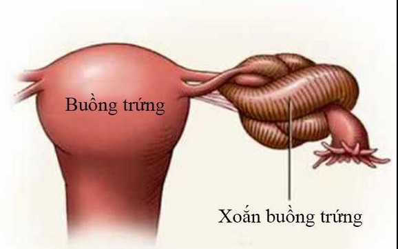 U nang buồng trứng ác tính có chữa được không?- Ảnh 2.