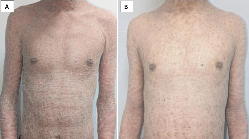 Vảy cá bẩm sinh: Bệnh da di truyền hiếm gặp cần được chăm sóc đúng cách - Ảnh 2.