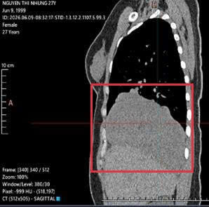 Gallery - Đau tức ngực kéo dài, cô gái 27 tuổi bất ngờ phát hiện khối u lớn trong lồng ngực - image 3