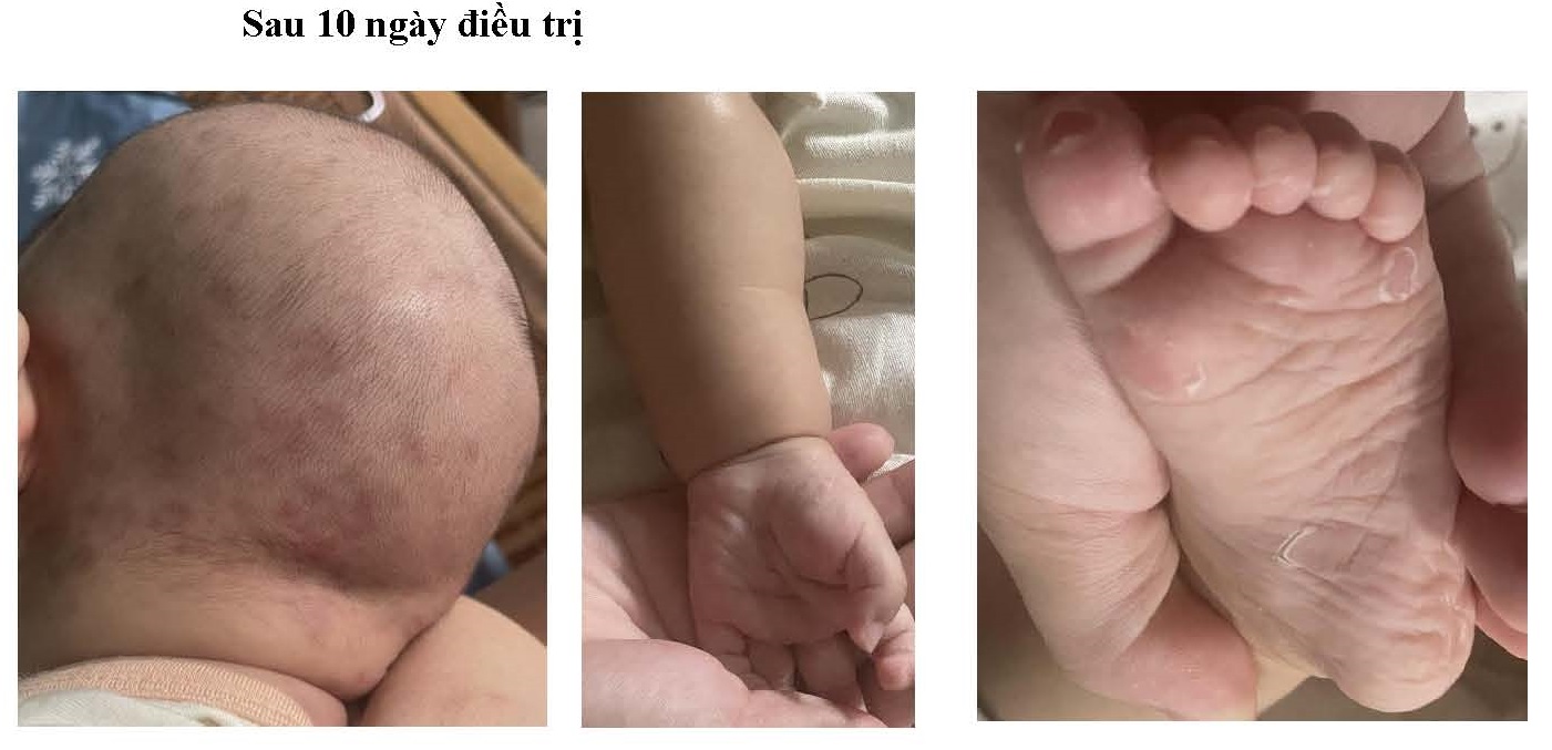 Bé gái 2 tháng tuổi mắc giang mai, nhầm sang viêm da cơ địa- Ảnh 2.
