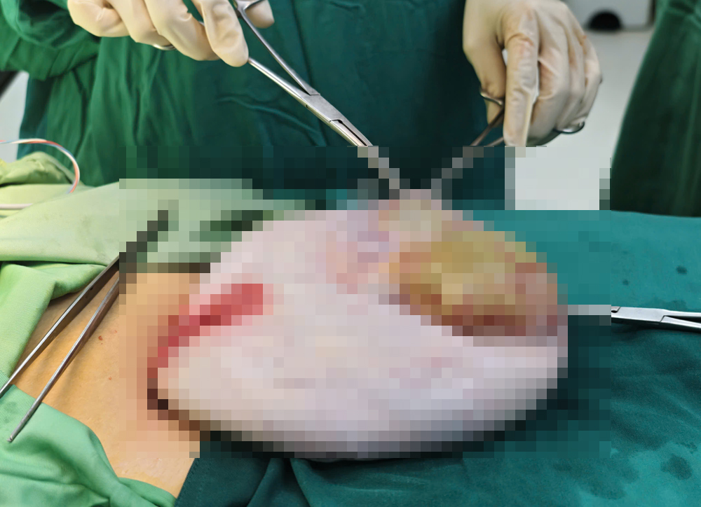 Gallery - Tưởng bụng to do tăng cân, bé gái 15 tuổi mang khối u gần 30cm - image 3
