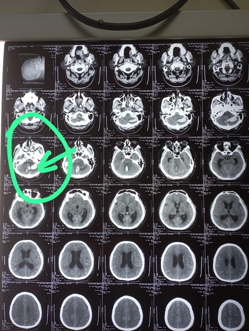 Gallery - Bác sĩ Bạch Mai cứu sống thầy giáo hôn mê sâu sau hành trình hơn 1.000km từ Lào về nước - image 2