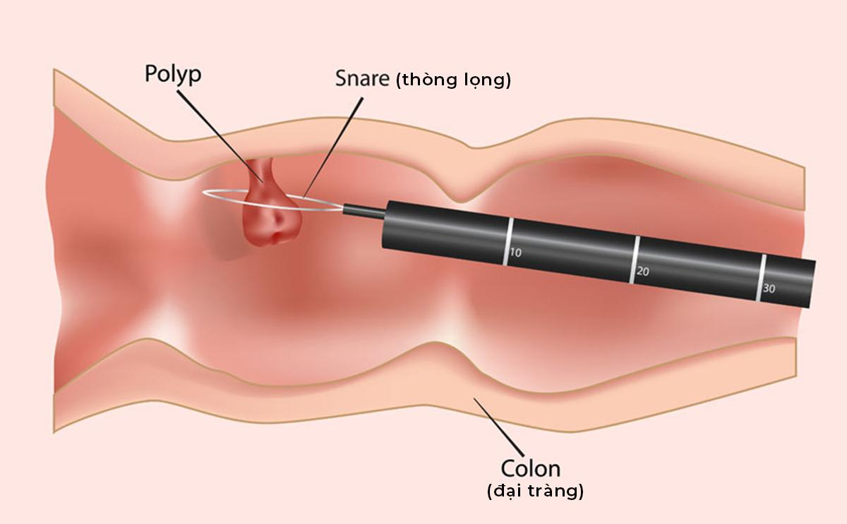 Ung thư không còn là nỗi sợ nếu phát hiện sớm - Ảnh 3.
