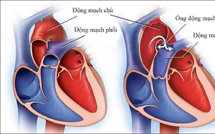 Bất ngờ phát hiện bệnh khi khám ở trường, bé trai được can thiệp kịp thời- Ảnh 2.