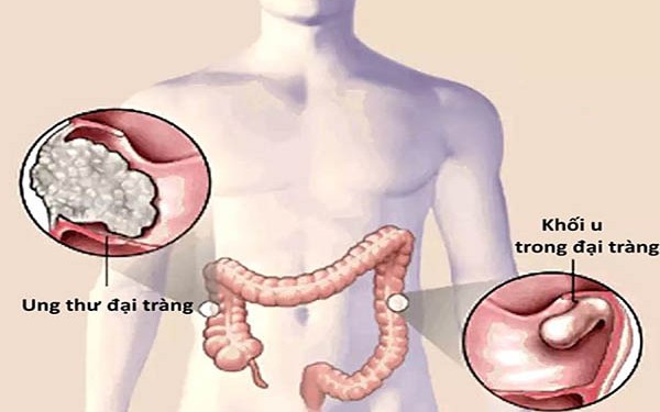 Ung thư đại trực tràng có chữa được không?- Ảnh 2.