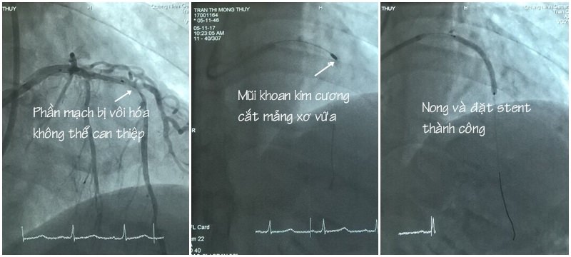 Hình ảnh trước và sau khi các bác sĩ tiến hành khoan mảng vôi bám, nong và đặt stent  cho bệnh nhân