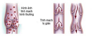 Điêu trị bệnh giãn tĩnh mạch chi dưới 1