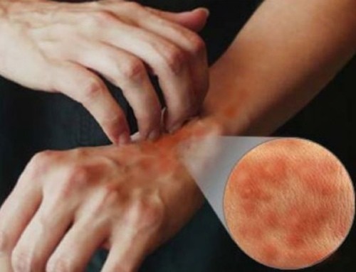 Ngứa, dùng thuốc thế nào cho hiệu quả? 1