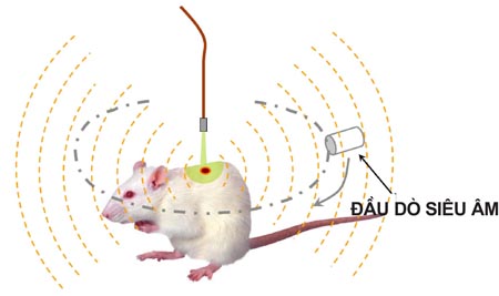 Phát hiện bệnh lý ở vú bằng kỹ thuật quang âm 3