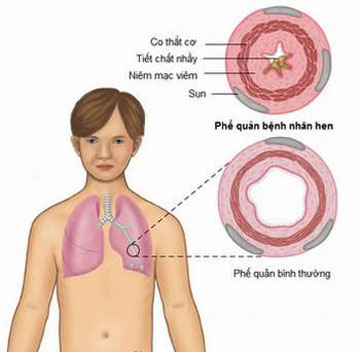 Điều trị dự phòng hen ở trẻ em 2