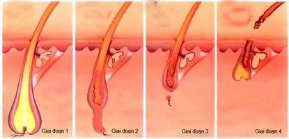 Bệnh viêm nang lông gia tăng 1