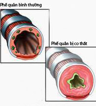 “Thủ phạm” gây bệnh hen suyễn 1 “Thủ phạm” gây bệnh hen suyễn 1