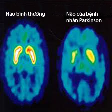 Cách chăm sóc bệnh nhân Parkinson 1