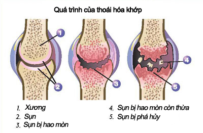 Khi các khớp “lên tiếng” 1