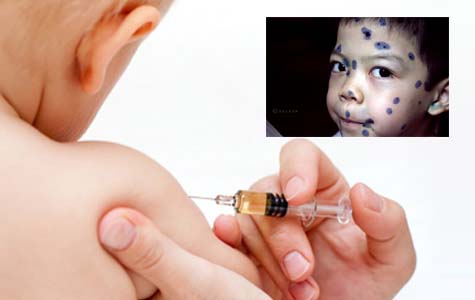 Mùa xuân, mùa của bệnh thủy đậu 1