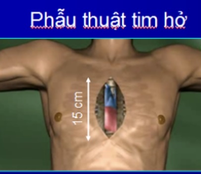 Phẫu thuật nội soi tim thay van hai lá 1