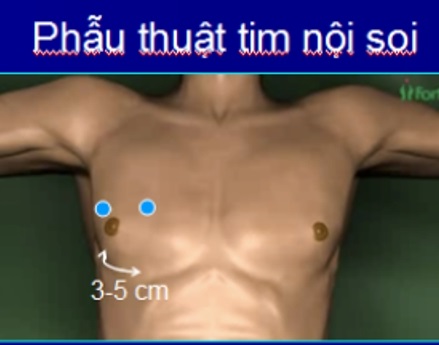 Phẫu thuật nội soi tim thay van hai lá 2