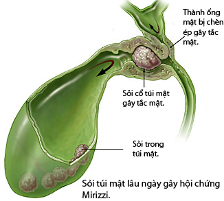 Sỏi túi mật và hội chứng Mirizzi 1