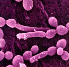 Tổn thương da và niêm mạc ở trẻ nhiễm HIV 2 Tổn thương da và niêm mạc ở trẻ nhiễm HIV 2