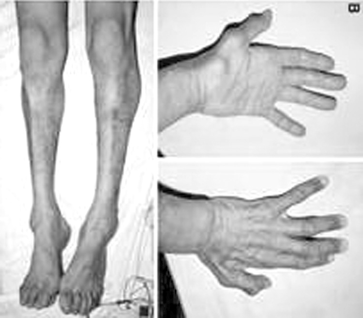 Viêm khớp dạng thấp cần điều trị sớm 1