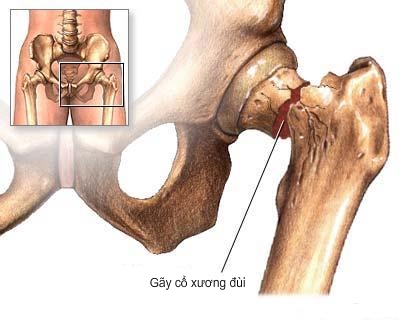 Phòng chống nguy cơ loãng xương ở người cao tuổi 1