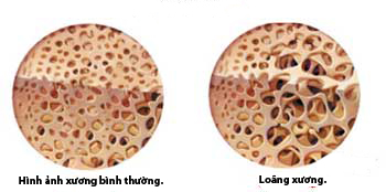 Điều trị loãng xương 1