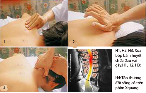 Cách xử trí đau vùng vai gáy 1