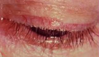 Quan điểm mới trong điều trị viêm mi 1