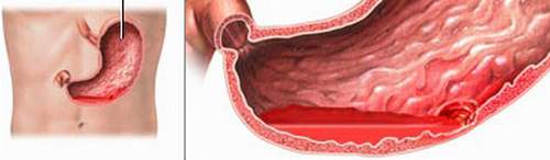 Xuất huyết tiêu hóa do đâu? 2