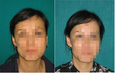 Ðiều trị teo lõm nửa mặt bằng bơm mỡ tự thân 1