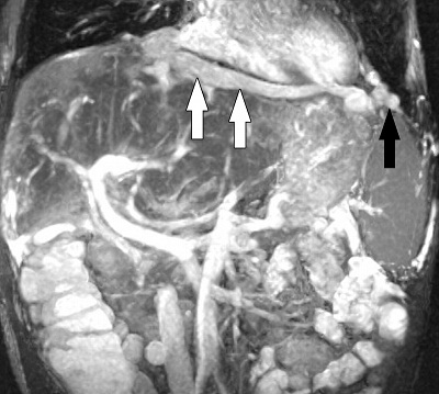 Tắc tĩnh mạch gan và hội chứng Budd - Chiari 1