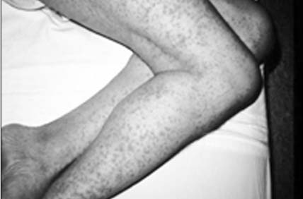 Nhận biết viêm thành mạch dị ứng 1