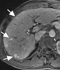 Tắc tĩnh mạch gan và hội chứng Budd - Chiari 2