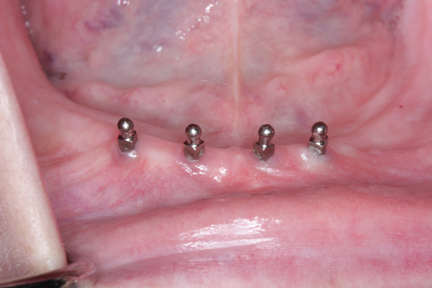 Mini-implant được chỉ định khi nào? 1