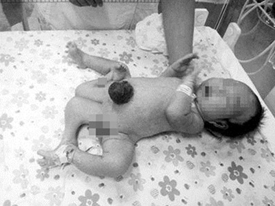 Em bé chào đời có 4 chân 1 Em bé chào đời có 4 chân 1