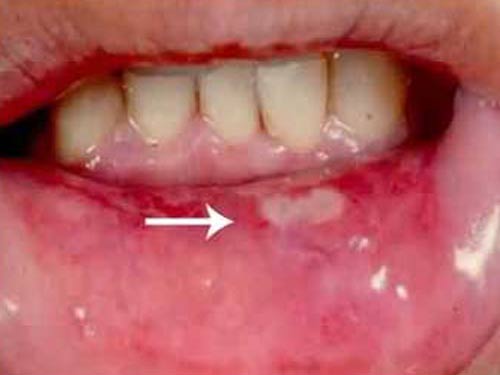 Chớ xem thường loét miệng ở trẻ 1