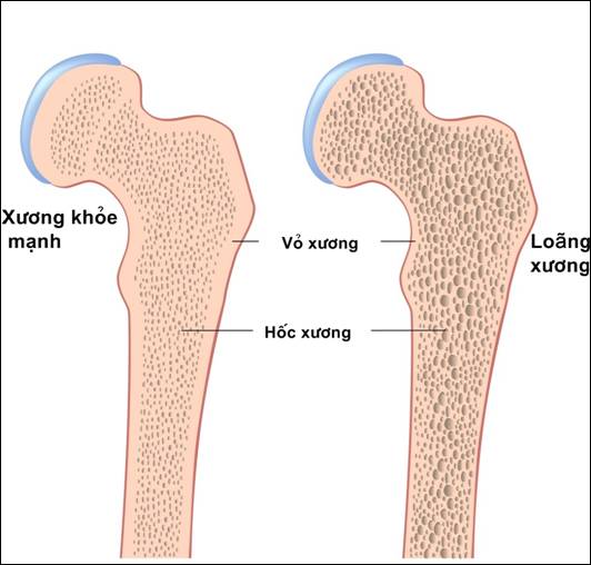Chọn thuốc chống loãng xương cho đúng 1