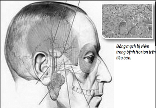 Triệu Chứng Điển Hình Khi Bị Sưng 2 Bên Thái Dương