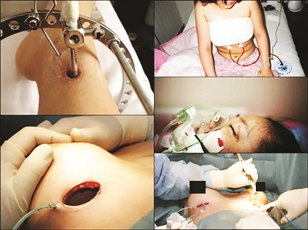 Tai biến trong phẫu thuật thẩm mỹ 1