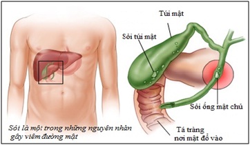 Nhận biết nhiễm khuẩn đường mật 1
