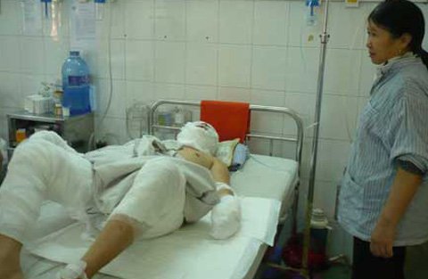 Xử trí cấp cứu bỏng đường hô hấp 1 Xử trí cấp cứu bỏng đường hô hấp 1