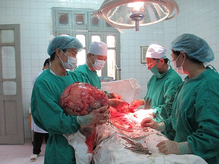 Mổ thành công khối u nang nặng 18kg 1