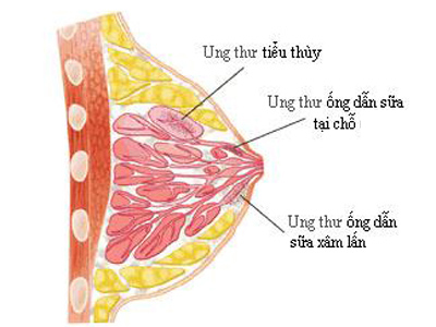 Một số thuốc và nội tiết liên quan đến bệnh ung thư 2