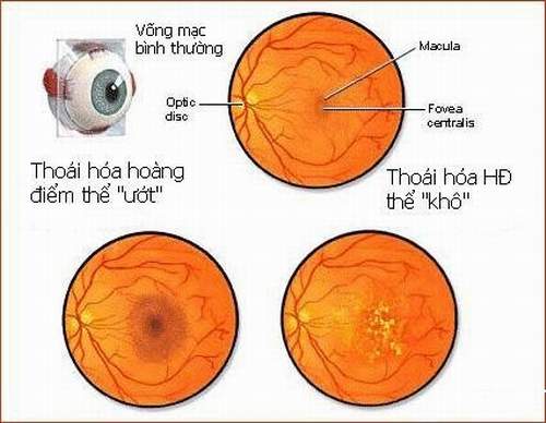 Nguy cơ mù lòa từ một số bệnh đáy mắt 2