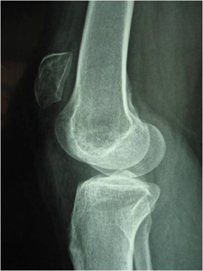 Tái tạo gân bánh chè bị đứt với ưu điểm vượt trội  1