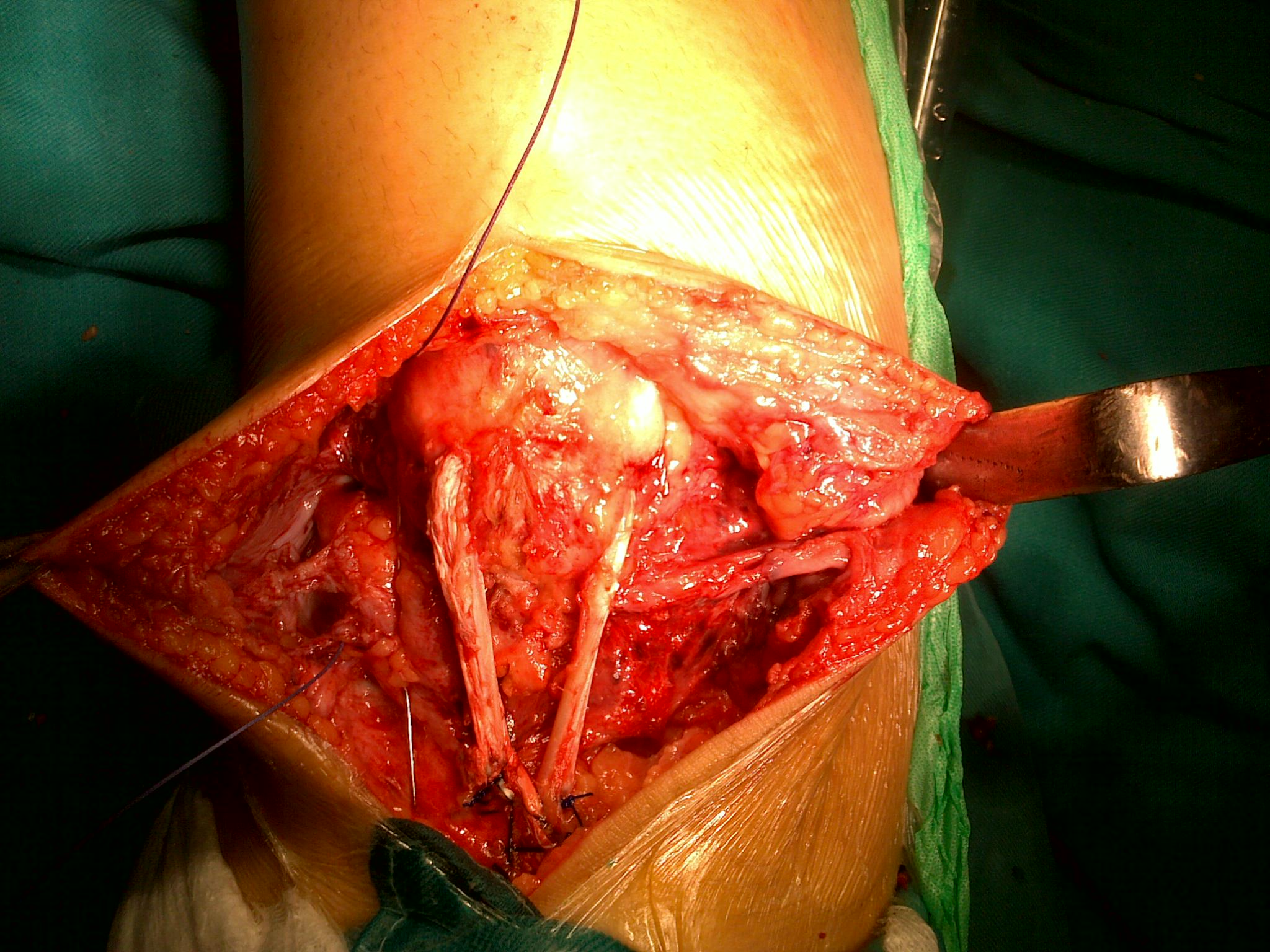 Tái tạo gân bánh chè bị đứt với ưu điểm vượt trội  2