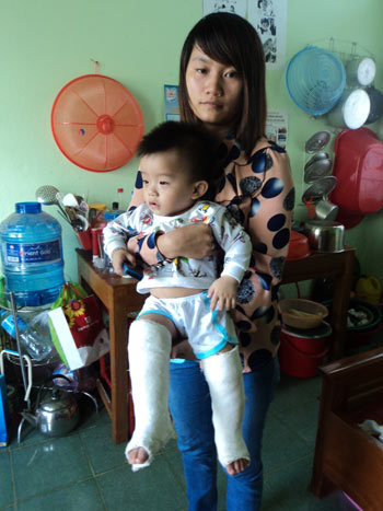Đón con ở nhà trẻ về thấy gãy cả 2 chân 1